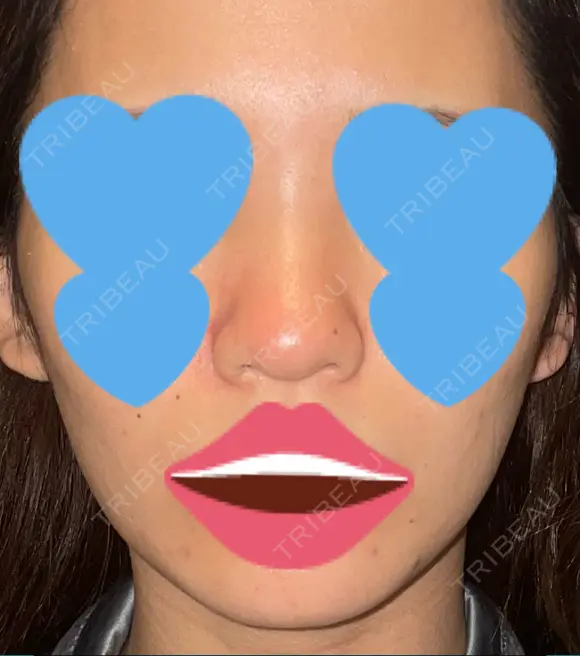 隆鼻術 / 鼻尖形成（切開） / 糸リフト / 軟骨移植 / ヒアルロン酸注入（頬） ASTRA BEAUTY CLINIC BEFORE メイン用