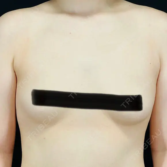 豊胸（シリコンバッグ） MYCLI【マイクリ】東京・恵比寿院 BEFORE メイン用