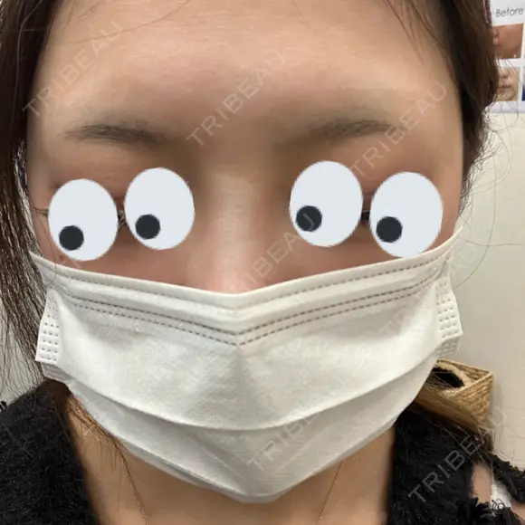 アートメイク（眉） TRUE DESIGN CLINIC BEFORE メイン用