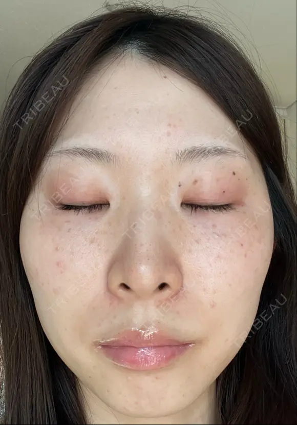 ピコレーザートーニング（美白・肝斑） PTクリニック六本木 BEFORE メイン用