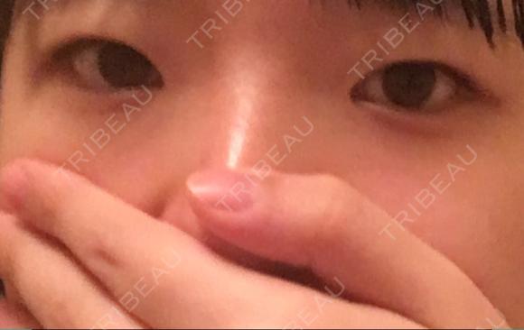 二重切開 / 上まぶたの脂肪取り 聖心美容クリニック 横浜院 BEFORE メイン用