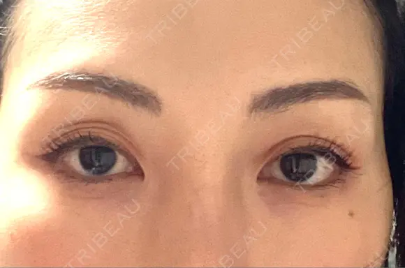 二重埋没 / 眼瞼下垂（非切開） フェアクリニック川口 BEFORE メイン用