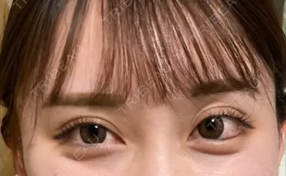 タレ目形成・グラマラスライン（切開） / タレ目形成・グラマラスライン（埋没） リッツ美容外科 東京院 BEFORE メイン用