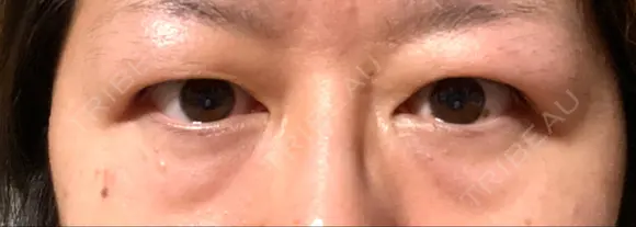 二重切開 / クマ治療 / 上まぶたの脂肪取り / 下まぶたの脂肪取り / その他（目元） ながしまクリニック BEFORE メイン用