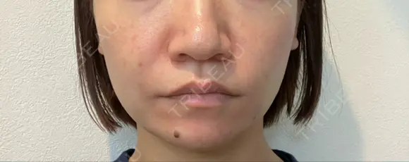 糸リフト 渋谷美容外科クリニック 渋谷院 BEFORE メイン用