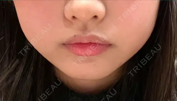 ボトックス（エラ・小顔） 湘南美容クリニック 名古屋栄院 BEFORE メイン用