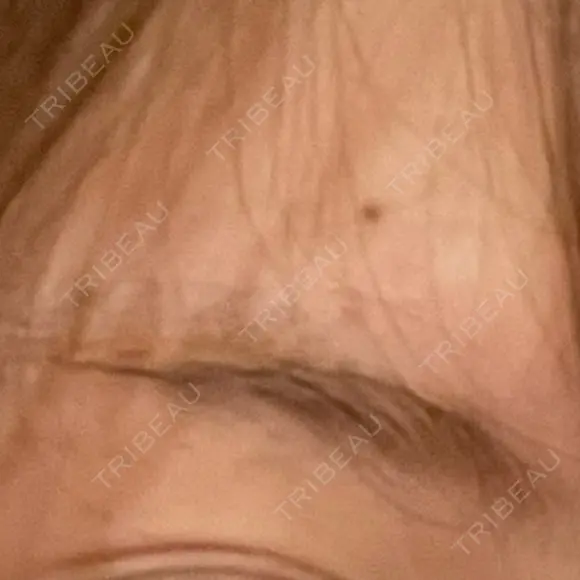 その他（目元） TRUE DESIGN CLINIC BEFORE メイン用