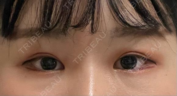 ヒアルロン酸注入（涙袋） プリモ麻布十番クリニック BEFORE メイン用