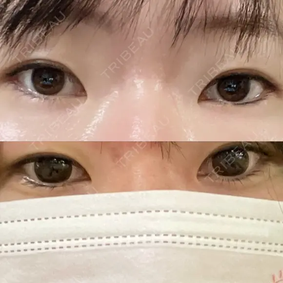 二重切開 / 目頭切開 聖心美容クリニック 札幌院 BEFORE メイン用