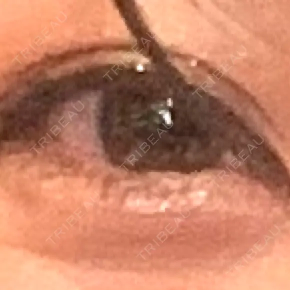 アートメイク（ほくろ） oneUPclinic BEFORE メイン用