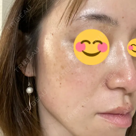 糸リフト / ボトックス（エラ・小顔） TCB東京中央美容外科 八王子院 BEFORE メイン用