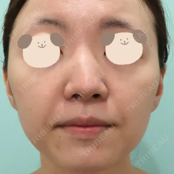 鼻尖形成（切開） / 小鼻縮小（切開） / 軟骨移植 / 骨切幅寄せ / 小鼻縮小（非切開） WOM CLINIC GINZA （ワム クリニック ギンザ） BEFORE メイン用