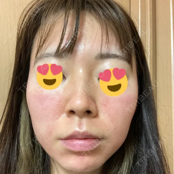 ダーマペン たかだウロクリニック BEFORE メイン用