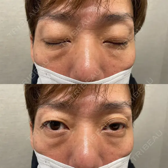 下まぶたの脂肪取り 東郷美容形成外科　福岡 BEFORE メイン用
