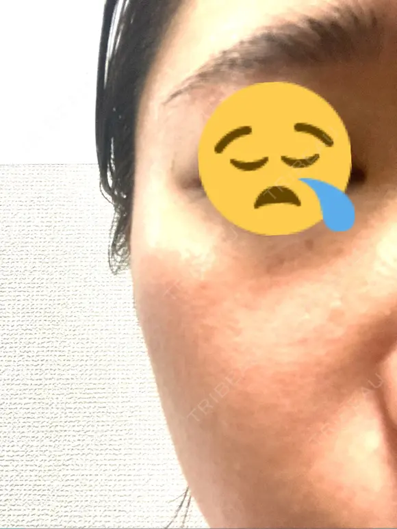 シミ取りレーザー / ピコレーザートーニング（美白・肝斑） Olino美容外科・美容皮膚科 BEFORE メイン用