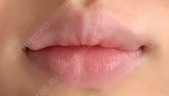 口唇縮小術 B-LINE CLINIC 池袋院 BEFORE メイン用