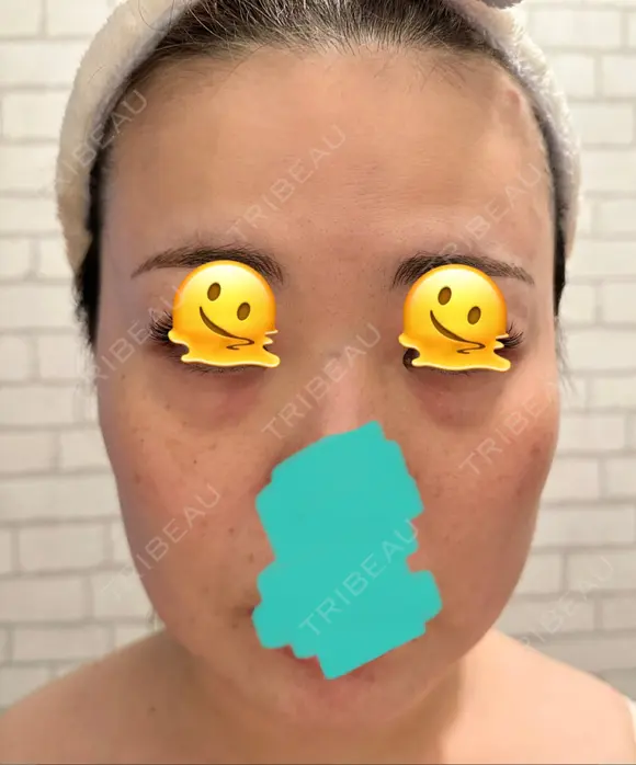 糸リフト / クマ治療 / 脂肪吸引（顔） / 脂肪注入（額） / ヒアルロン酸注入（あご） / ボトックス（エラ・小顔） / 脂肪注入（輪郭） / ボトックス（額） X CLINIC 福岡天神院 BEFORE メイン用