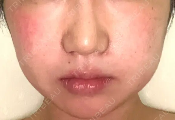 バッカルファット除去 / 脂肪吸引（顔） / ジョールファット除去 WOM CLINIC GINZA （ワム クリニック ギンザ） BEFORE メイン用