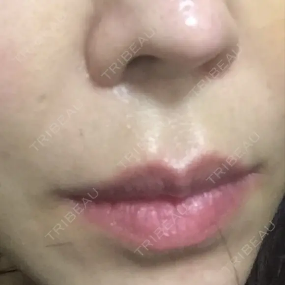 人中短縮 / 口唇縮小術 / 口角挙上 HB整形外科 BEFORE メイン用
