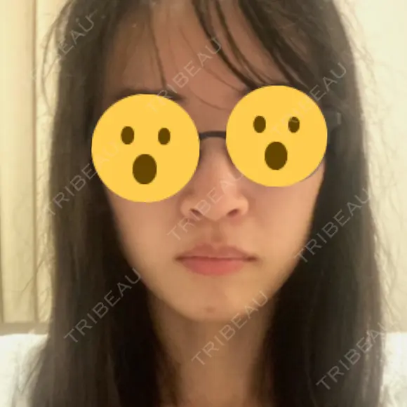 鼻尖形成（切開） / 鼻中隔延長（切開） / 小鼻縮小（切開） / 軟骨移植 / 骨切幅寄せ / ワシ鼻修正・ハンプ切除 / 鼻尖縮小 HANABI整形外科 BEFORE メイン用
