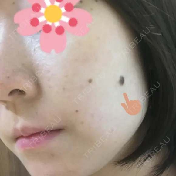 ほくろ・いぼ切除（肌） 甲府昭和形成外科クリニック BEFORE メイン用