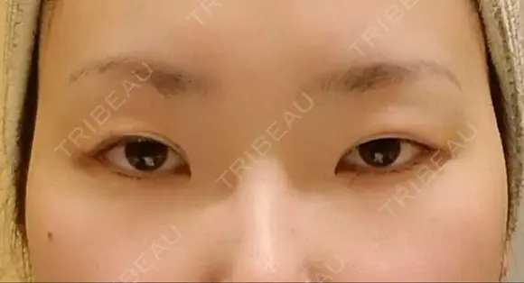 二重切開 / 目頭切開 / 眼瞼下垂（切開） / 目元修正 聖心美容クリニック 札幌院 BEFORE メイン用