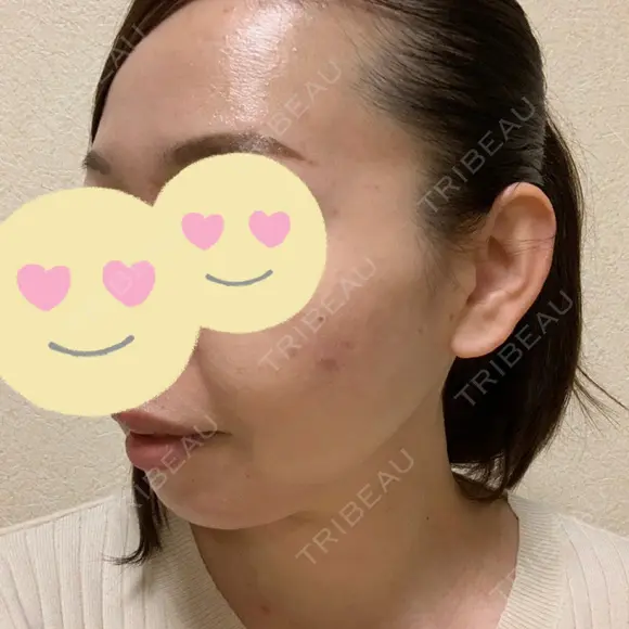 脂肪吸引（顔） / 脂肪注入（肌） / ヒアルロン酸注入（あご） / ボトックス（エラ・小顔） / ダーマペン Mods Clinic（モッズクリニック） 大阪院 BEFORE メイン用