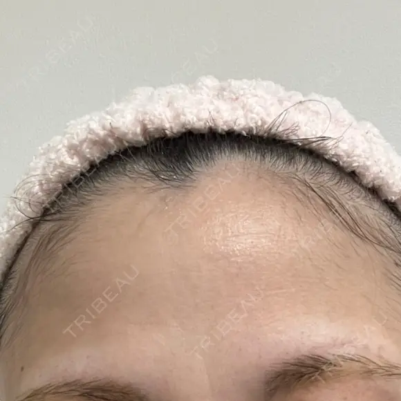 ピーリング（ニキビ・毛穴） 成城スカイファミリークリニック BEFORE メイン用