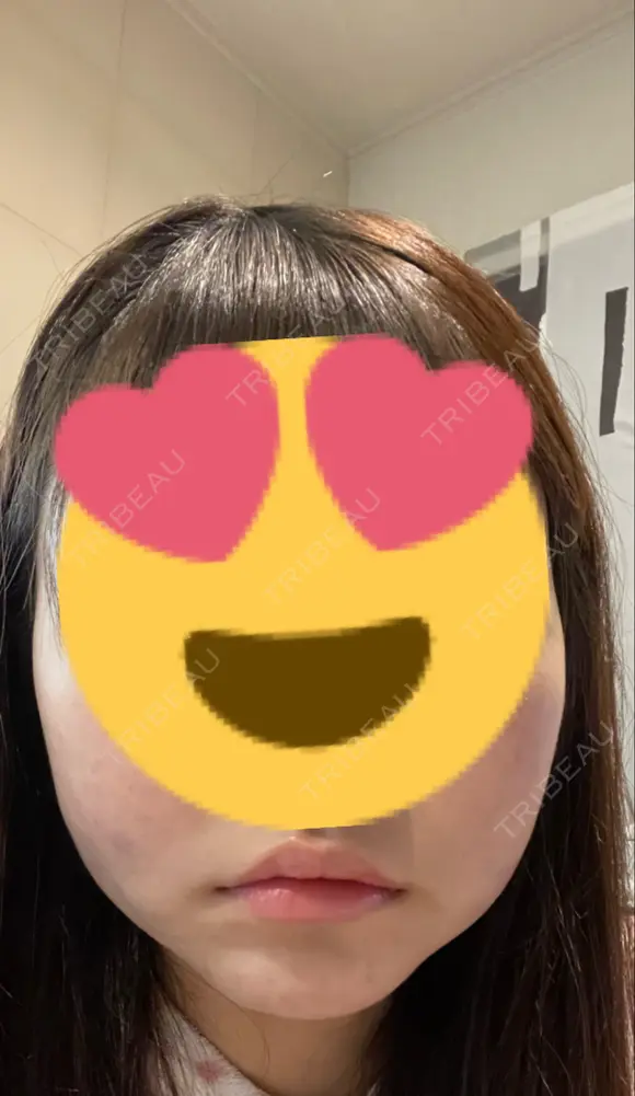 糸リフト / バッカルファット除去 / 脂肪吸引（顔） ブルームクリニック（BLOOM CLINIC） BEFORE メイン用