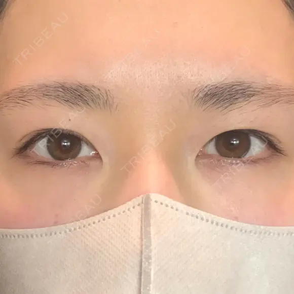 二重埋没 アリエル美容クリニック 郡山院 BEFORE メイン用