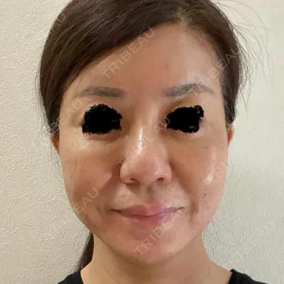 隆鼻術 / 軟骨移植 / 鼻尖縮小 エースクリニック 名古屋院 BEFORE メイン用