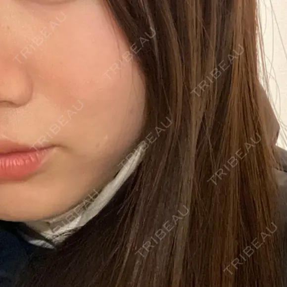 ピコレーザートーニング（美白・肝斑） / ピコフラクショナルレーザー（毛穴・ニキビ跡） SK新宿歌舞伎町美容外科・歯科 BEFORE メイン用