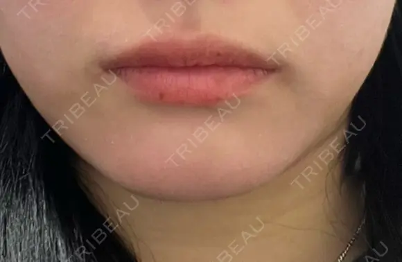 ヒアルロン酸注入（涙袋） / 肌ヒアルロン酸注入（たるみ・シワ改善） / ヒアルロン酸注入（唇） / ヒアルロン酸注入（額） / ヒアルロン酸注入（頬） LA CLEF CLINIC（ラクレクリニック） BEFORE メイン用