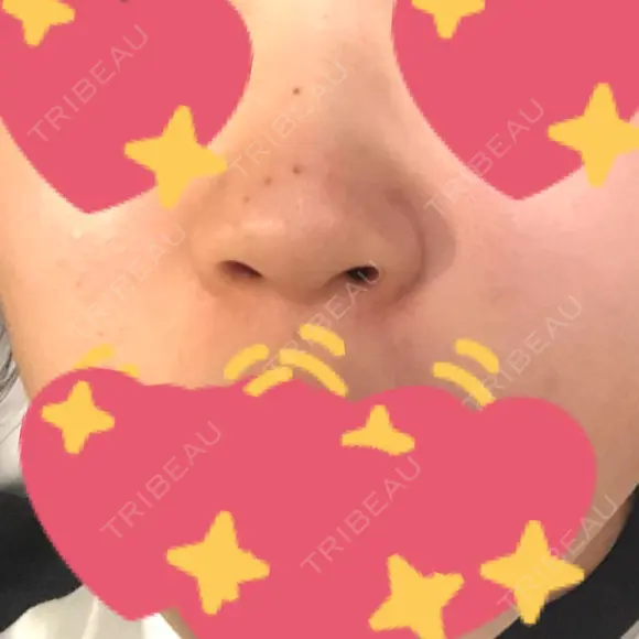 隆鼻術 / 鼻尖形成（切開） / 鼻中隔延長（切開） / 軟骨移植 R Beauty CLINIC 名古屋院 BEFORE メイン用