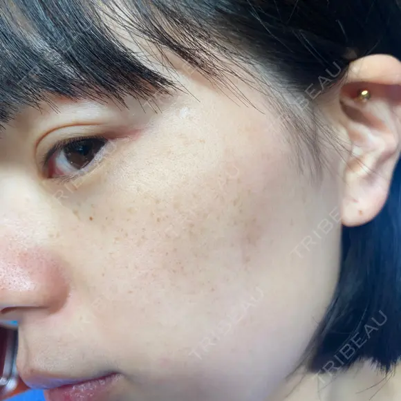 光治療（フォトフェイシャルなど） 椿クリニック 名古屋院 BEFORE メイン用