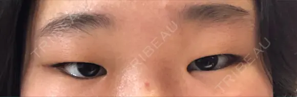 二重埋没 城本クリニック 富山院 BEFORE メイン用