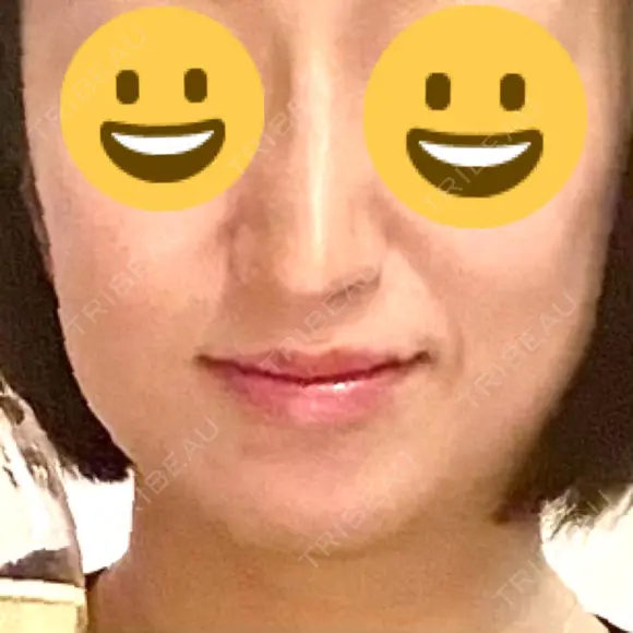 ボトックス（エラ・小顔） / 脂肪溶解注射（顔） / 脂肪溶解注射 渋谷美容外科クリニック 渋谷院 BEFORE メイン用