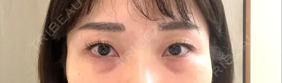 下まぶたの脂肪取り / 脂肪注入（目の下） セオリークリニック BEFORE メイン用