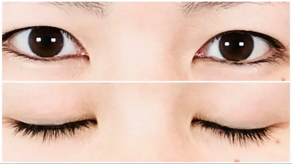 二重埋没 アリエル美容クリニック 郡山院 BEFORE メイン用