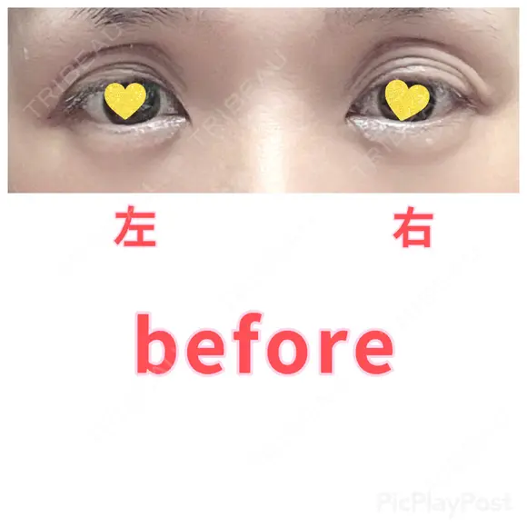 二重切開 / 眼瞼下垂（切開） / 上まぶたたるみ取り 心斎橋形成外科スキンケアクリニック BEFORE メイン用