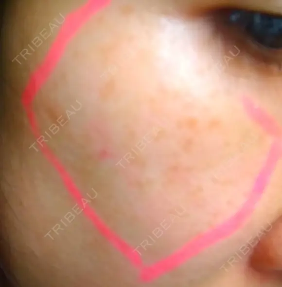 シミ取りレーザー / YAGレーザー 新宿美容外科クリニック 新宿院 BEFORE メイン用