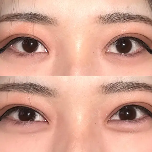 ヒアルロン酸注入（涙袋） / ボトックス（タレ目） アネシス美容クリニック BEFORE メイン用