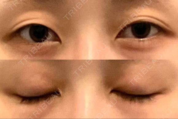 二重埋没 アリエル美容クリニック 郡山院 BEFORE メイン用
