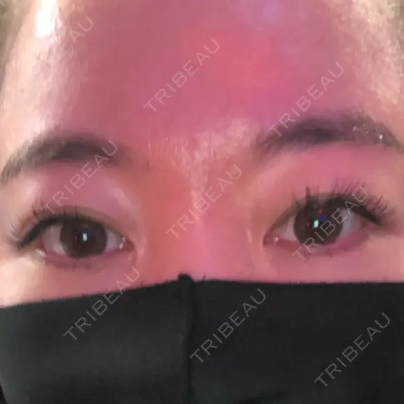 二重埋没 / 上まぶたの脂肪取り アリエル美容クリニック 郡山院 BEFORE メイン用