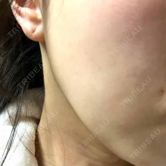 ピーリング（ニキビ・毛穴） まゆりなclinic 名古屋栄 BEFORE メイン用