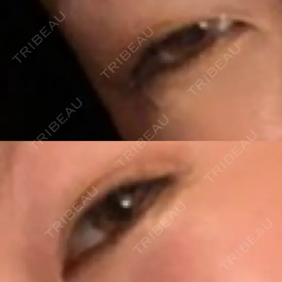二重埋没 Olino美容外科・美容皮膚科 BEFORE メイン用