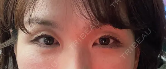 二重切開 / 上まぶたたるみ取り 心斎橋形成外科スキンケアクリニック BEFORE メイン用