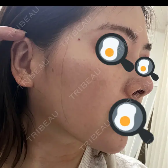 光治療（フォトフェイシャルなど） / ルメッカ クリニックTEN渋谷 BEFORE メイン用