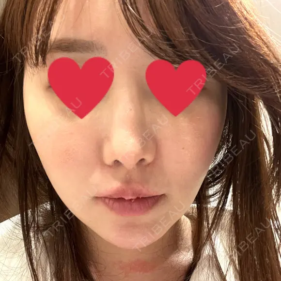 鼻翼基部形成（貴族手術） 新宿ラクル美容外科クリニック 新宿院 BEFORE メイン用