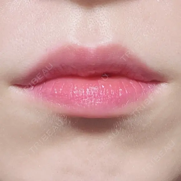 ヒアルロン酸注入（唇） TCB東京中央美容外科 梅田茶屋町院 BEFORE メイン用